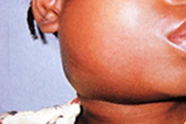 DHMT AWARE OF MUMPS OUTBREAK IN MASERU