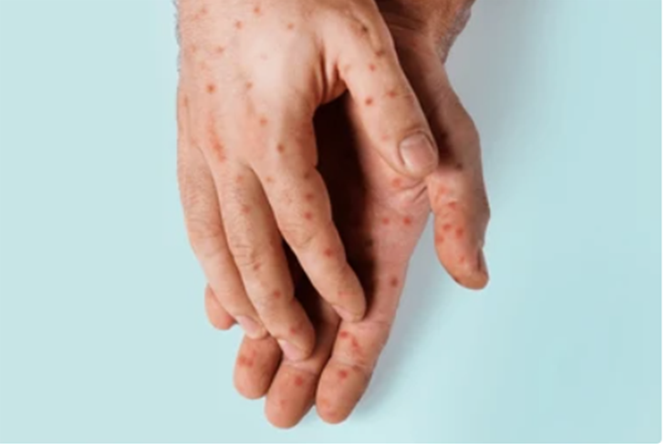MPOX DECLARED GLOBAL EMERGENCY