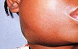 DHMT AWARE OF MUMPS OUTBREAK IN MASERU