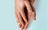 MPOX DECLARED GLOBAL EMERGENCY